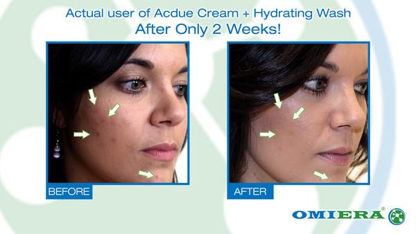 Acdue Hydrating Wash: Anti-Aging and Acne Cleanser ( 7.0 Fl. Oz) - image 2