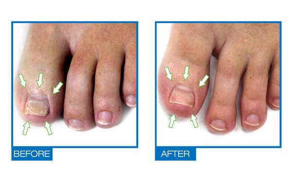 Omiera Labs Podiazole Toenail Fungus Treatment, Nail Whitener, Anti Fungal Treatment (1.0 fl oz) - image 2