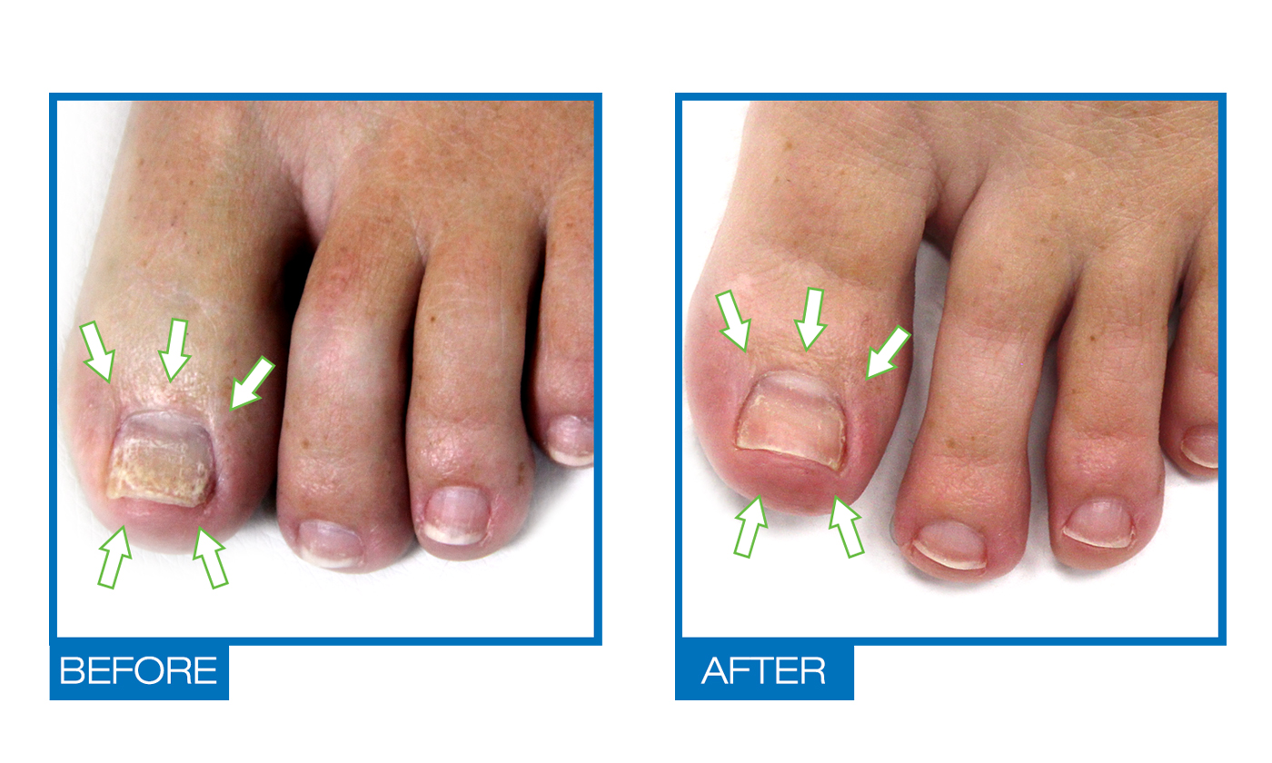 Podiazole Toenail , Fingernail Fungus Treatment, Nail Whitener - image 4