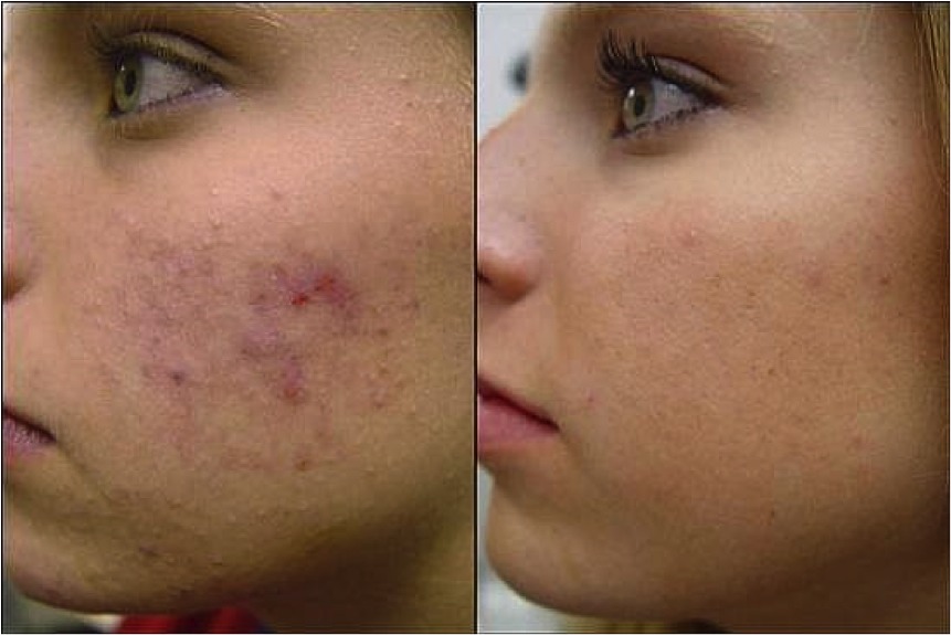 To get rid of acne use tea tree oil every night before you go to bed apply a small amount with a q-tip on all effected areas . 