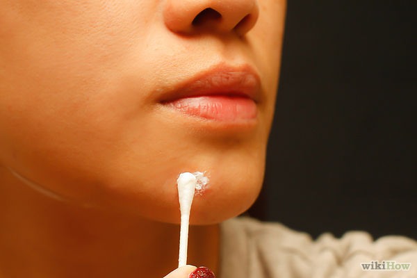 Benzoyl peroxide comes in a variety of forms, but most are creams or gels. You apply it to breakouts only - it kills the bacteria that causes inflammation in blocked pores. Be patient, though; results can take up to three weeks. Don't increase your usage! Too much is a bad thing, too.