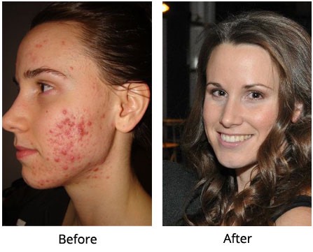 MY SKIN CLEARED UP SO MUCH!! This isn't me but my before and after was similar. 