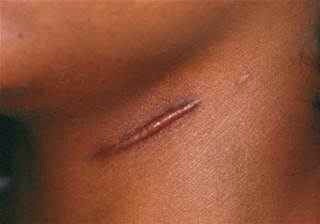Scars: Honey has a bleaching effect so regular use on new scars can get rid of them over time