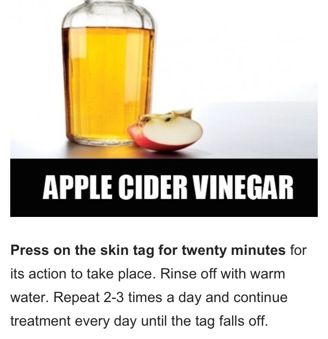 Home Remedies To Remove Skin  Tags 