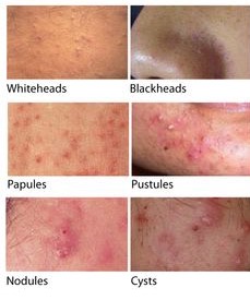 7. What are the different types of acne?
Your pores are lined with skin cells, the lining grows & blocks the pore. When the opening gets blocked you get a whitehead. If the top of the skin breaks open & the oil in the pore reaches air & oxidizes, that's a blackhead. If the follicle is blocked completely the protein and fat from the oil start to grow, this causes a red pimple. If you pick at the pimple, an immune response is sent creating a cascade of redness & inflammation, causing a pustule.