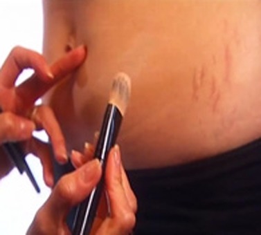 Another way is makeup. There are a lot of body makeups on the market that work great at covering them up. You can find some at most major cosmetics stores 