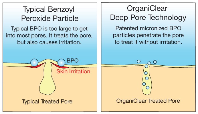 Kick Acne's Butt! My Daily Routine