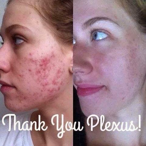 How To Get Rid Of Acne