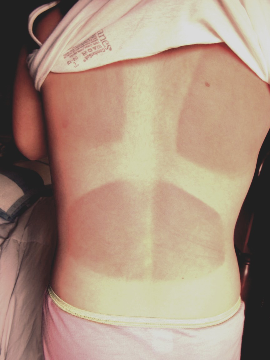 For Sunburn 
Soak a wash cloth in ACV and apply to affected area. 