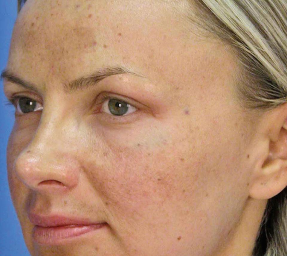 Sleeping with makeup on can actually age your skin by six days. This doesn't seem many days but as you sleep in it more and more times, more and more days are added to ageing your skin. This is why it is so important to make sure it is all removed.