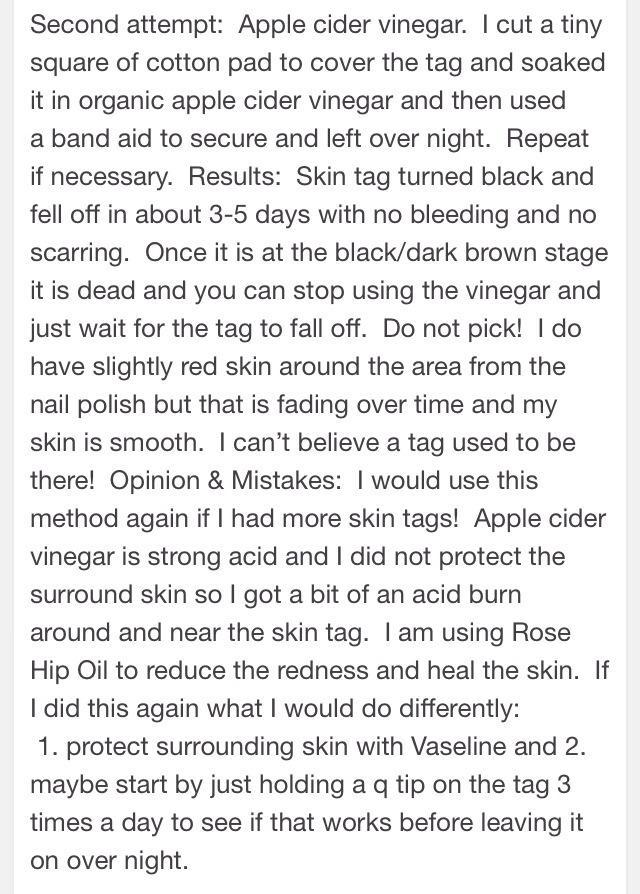 How To Remove Skin Tags With One Simple Ingredient1