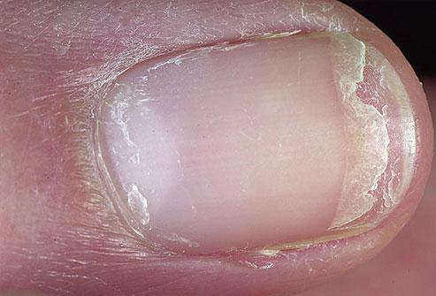 Cracked or Split Nails
Dry, brittle nails that frequently crack or split have been linked to thyroid disease. Cracking or splitting combined with a yellowish hue is more likely due to a fungal infection