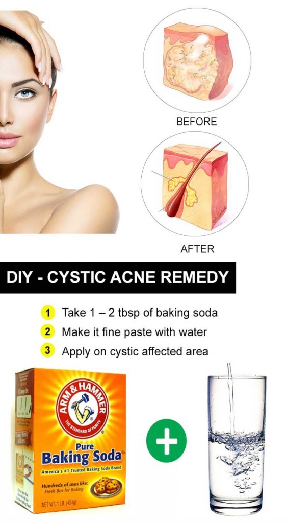 How To Get Rid Of Body Acne💕✨👍❤️