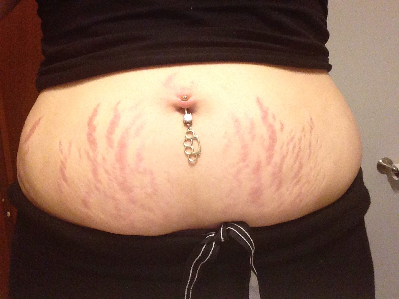 Use bio oil to get rid of stretch marks! It has
To be applied twice daily everyday to ensure the marks go down 