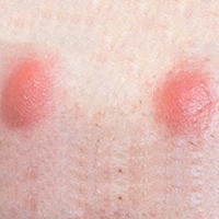 Nodules
Nodules are much larger in size than popules and pustules and can be really painful. Unlike other types of inflamed acne spots, it can take many months to get rid of nodules and, in some cases, you will be able to remove nodule only with the dermatologists help.