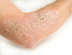 DIY Psoriasis,eczema And Skin Discoloration Cream #tip It