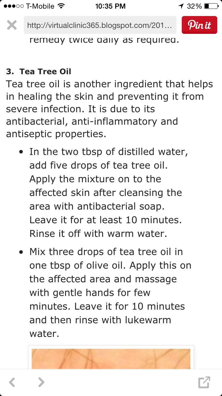 How To Get Rid Of Ingrown Hair! 