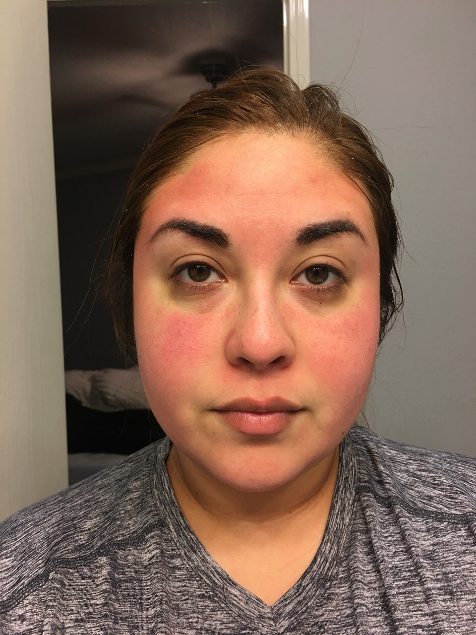 After the first time using this is what my skin looked like. You can see in the picture just how sensitive my skin is, the redness is due to a thorough exfoliation lol! 

After I washed the mask my skin felt smooth and so clean! The redness only lasted a few minutes
