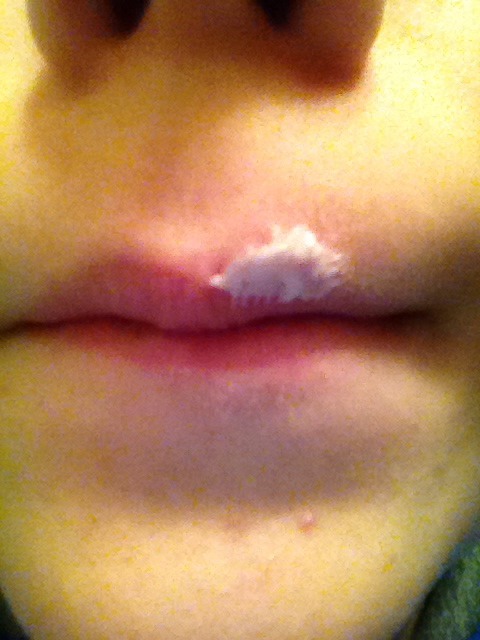 Apply to cold sore and remove in 1-2 hours! Don't forget to like!
