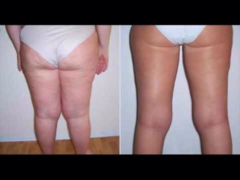 Get Distributor Prices On All Weight Loss Body Contouring Skinny Wraps 90 Day Challenge 