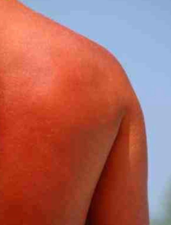 2. Cold Compress
You know a nice cool shower of bath will cool a fiery sunburn, but lying in cold water might be a bit chilly after a while. Instead, you can apply a cold cloth or a few ice cubes wrapped in a towel directly to the burn.

