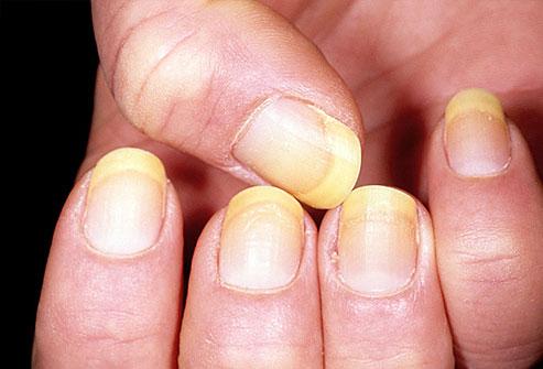 Yellow Nails
One of the most common causes of yellow nails is a fungal infection. As the infection worsens, the nail bed may retract, and nails may thicken and crumble. In rare cases, yellow nails can indicate a more serious condition such as severe thyroid disease, lung disease, diabetes or psorias