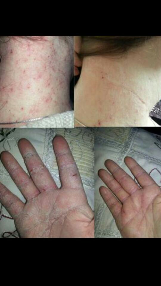 do you suffer from a skin condition? acne? Psoriasis?  dry skin?