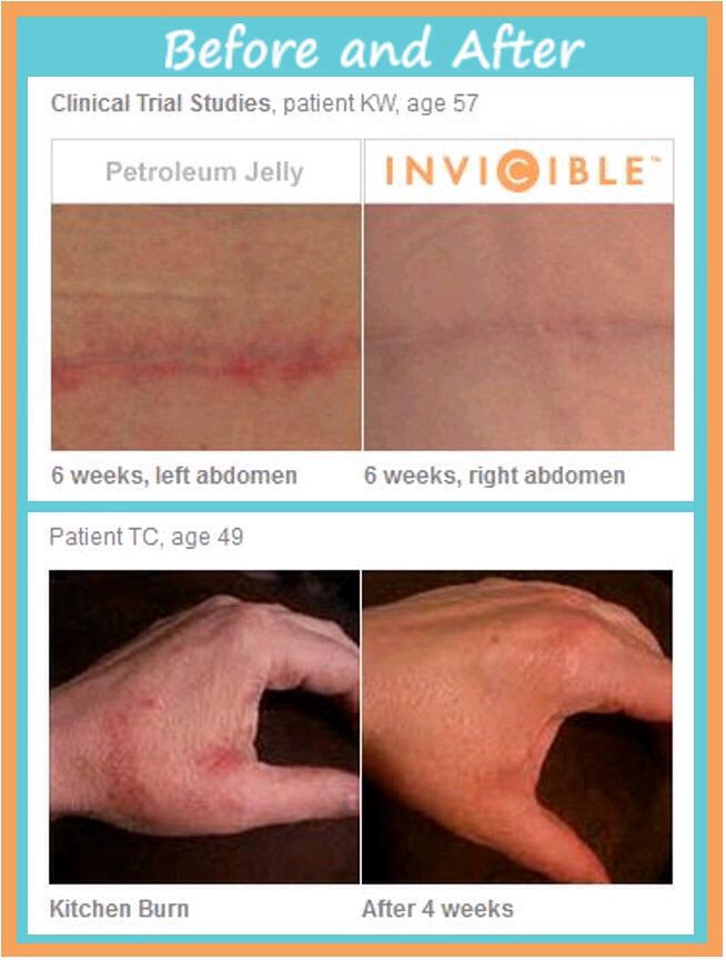 Get Rid Of Dark Spots From Acne ..etc !