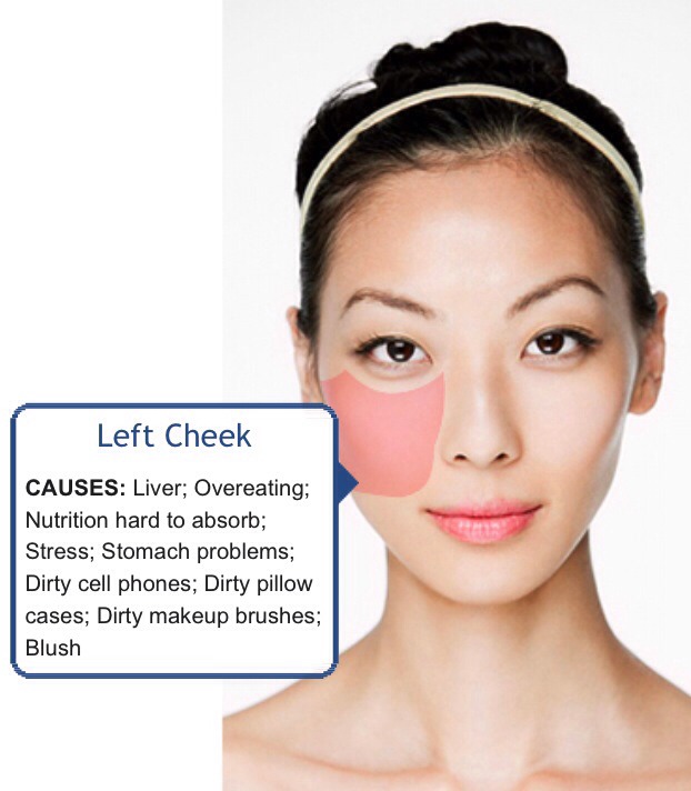Face Mapping (Acne) - What Is Your Acne Telling You? 