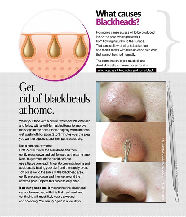 2. Buy a little tool (blackhead extractor) to try to get them out. Revlon makes a cheap one.