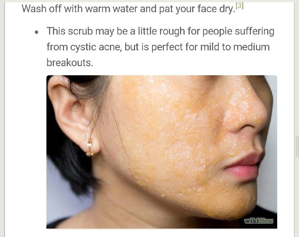 Tea Tree Oil for Acne
