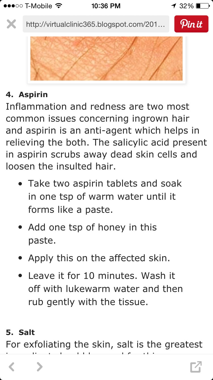 How To Get Rid Of Ingrown Hair! 