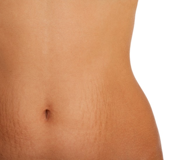Stretch mark prevention
Apply coconut oil to stretching skin multiple times a day.