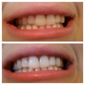 Natural Teeth Whitening😁✨👌
