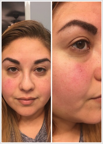 Before the first application, you can see the redness and irratiation in my skin...and my pores are huge!

When I received the brightening face mask and lemon soap I could smell it through the package! This dry mask smells so fresh and clean, just like lemons! 
