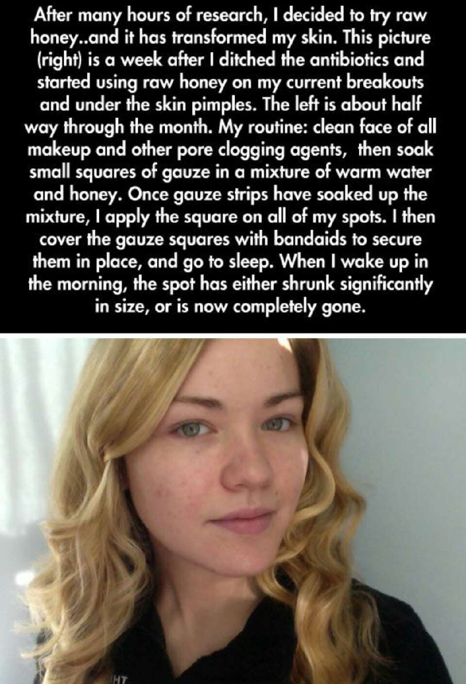 Natural Acne Prevention/ Treatment, bye bye Antibiotics! 
