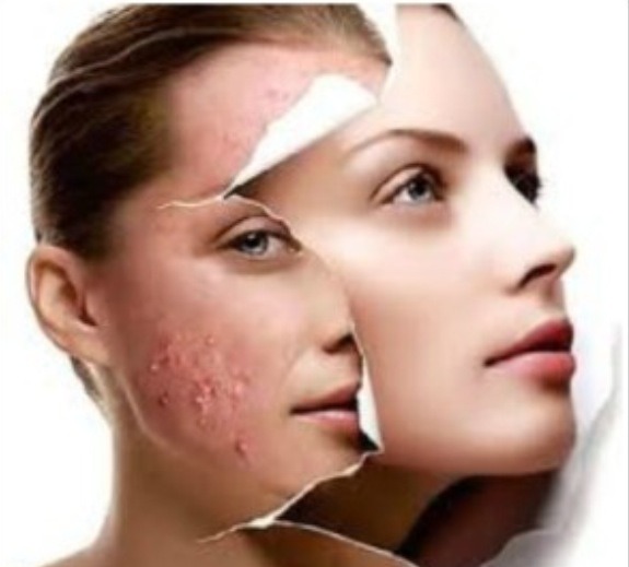 1. Acne