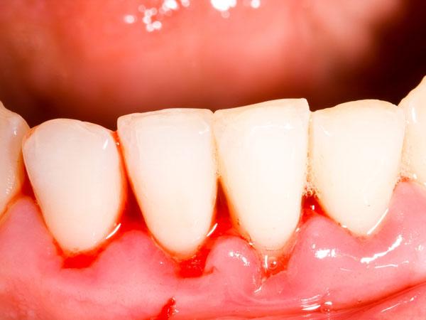 Bleeding Gums Some of the cold-pressed oils used for pulling benefits oral health. It helps strengthen the gums, fight cavity and reduce sensitivity.