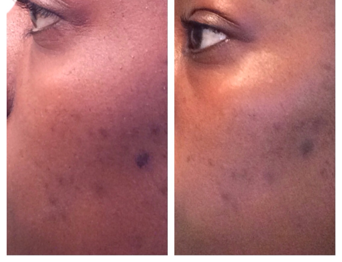 Do you see the awful acne scar in the before picture?? Now it's pretty much gone in the after photo! Get real results now!