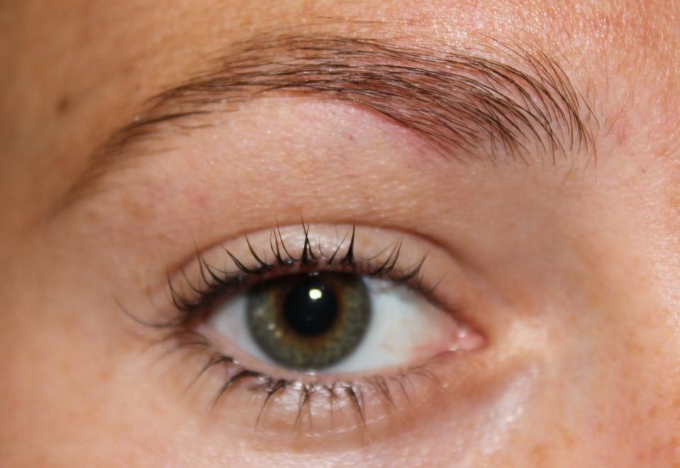 Above the brow. The area above the brow is affected by your immune system. Breakouts here tend to happen right before, after, or during a cold or flu. If you notice a breakout in this zone, slow down for a couple days, drink plenty of water