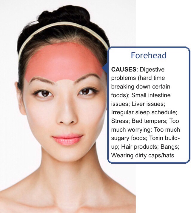 Face Mapping (Acne) - What Is Your Acne Telling You? 