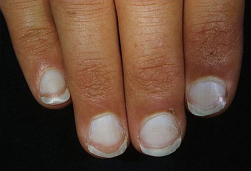White Nails
If the nails are mostly white with darker rims, this can indicate liver problems, such as hepatitis. In this image, you can see the fingers are also jaundiced, another sign of liver trouble.