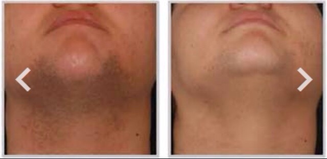 π Recipe For Facial Hair Removal!π