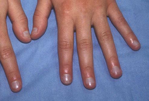 Bluish Nails
Nails with a bluish tint can mean the body isn't getting enough oxygen. This could indicate a lung problem, such as emphysema. Some heart problems can be associated with bluish nails