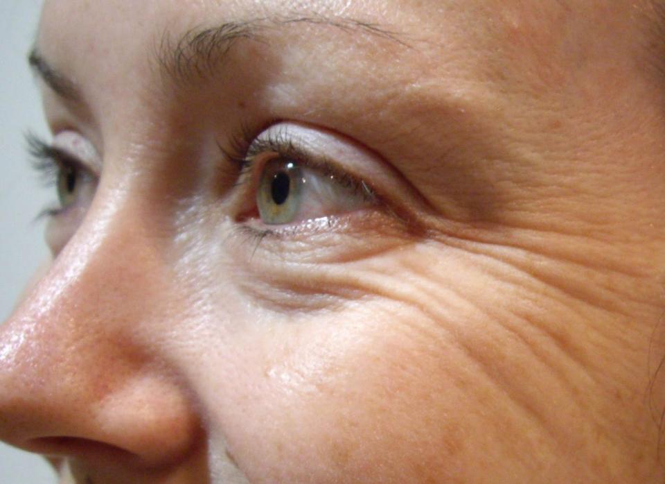 Preventing Wrinkles
Use coconut oil on the area around your eyes to prevent wrinkles and under-eye bags.
