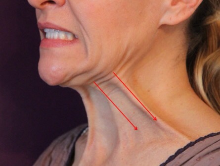 2. Platysma Exercise