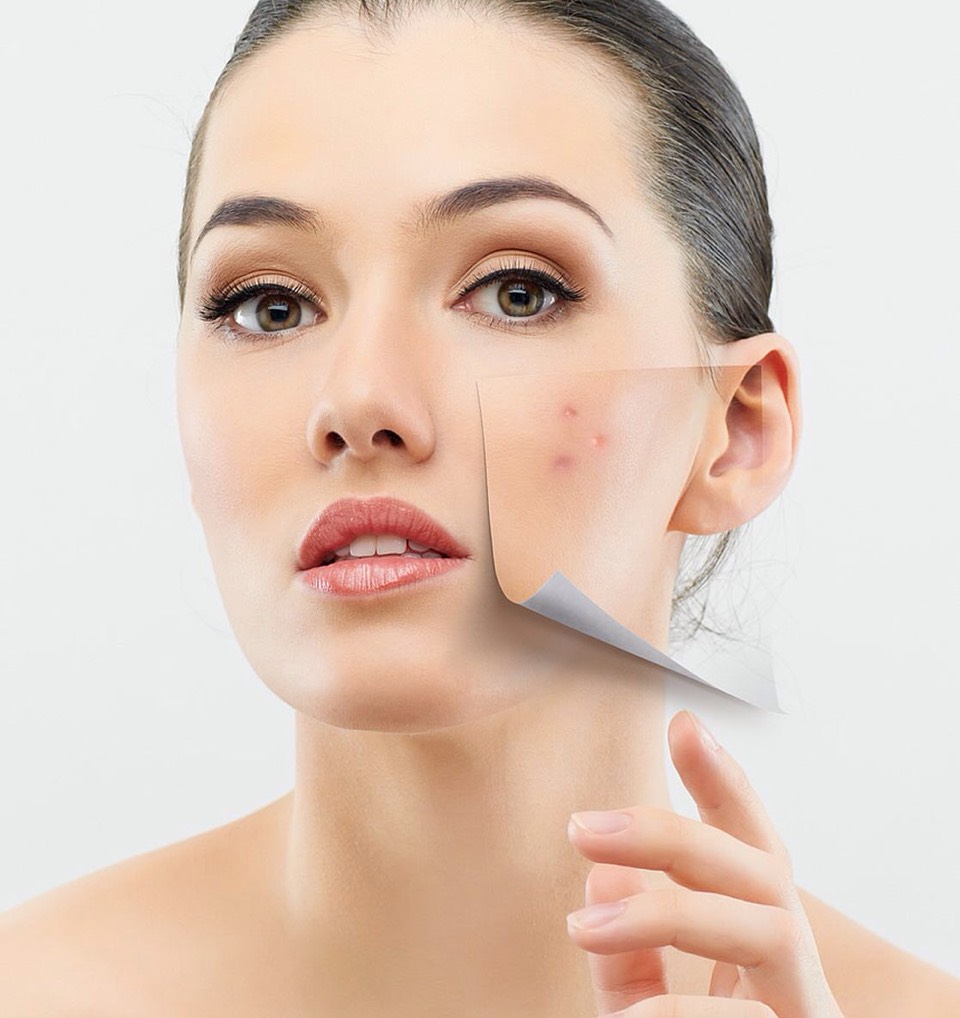 4. Treat your acnee, you can't have a clear skin if you don't treat the acnee you already have. 