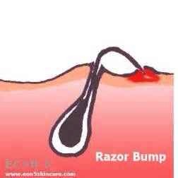 Ingrown hairs and razor bumps: apply honey right after shaving to prevent razor bumps and ingrown hairs