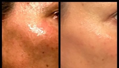 11. How do I get even skin tone?
Prevention is key; Use sunscreen religiously to prevent dark spots that rise to the surface due to too much sun exposure from cropping up. Exfoliate regularly to keep your skin cells shedding at a regular rate, which helps cell turnover and promotes an even complexion. Use products that contain antioxidants, like retinol, vitamin C, and niacinamide, which can help lighten any acne marks or sun spots.