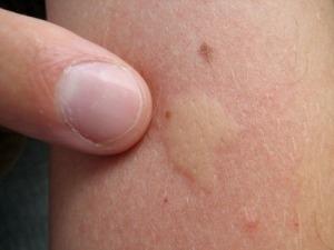 Orajel will stop mosquito bites from itching immediately.A pinner says: “This is a sure fix for mosquito bites. Every time you get bitten by a mosquito, use Orajel or any toothache gel medicine and it works! It stops the itching instantly and will not itch again. It isn’t greasy, sticky, or smelly. 
